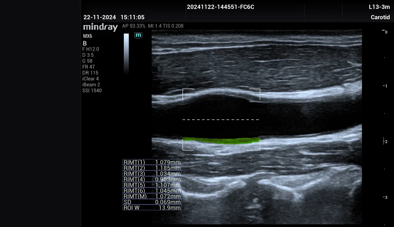 R-IMT — espesor íntima-media