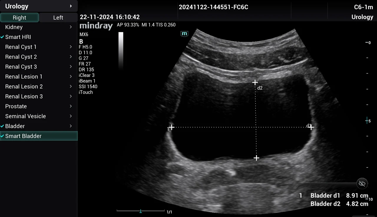 Smart Bladder