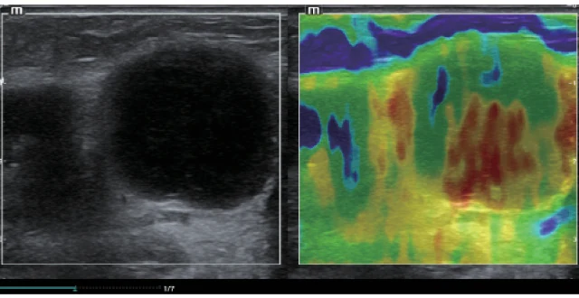 Elastografía Natural Touch en el Mindray MX7