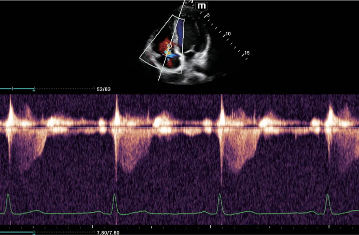 Insuficiencia tricuspídea