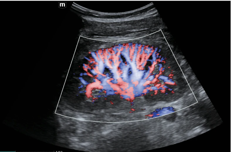 Perfusión renal