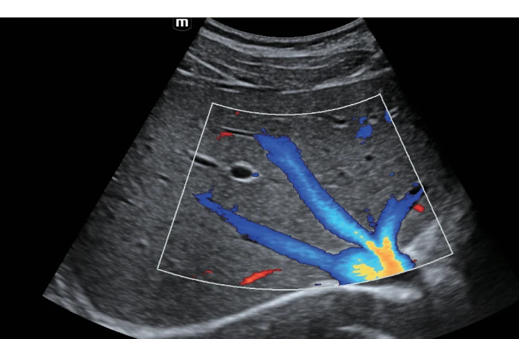 Vena hepática