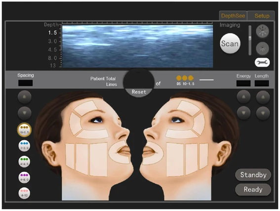 Pantalla de tratamiento del Nubway HIFU Mini con la manija 2D: zonas del rostro y ajuste de la línea