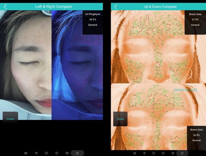 Pantallas de comparación izquierda y derecha y arriba y abajo del Nubway Skin Analyzer