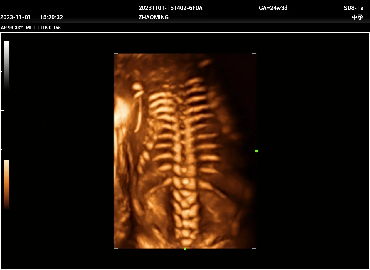 Columna fetal en 3D