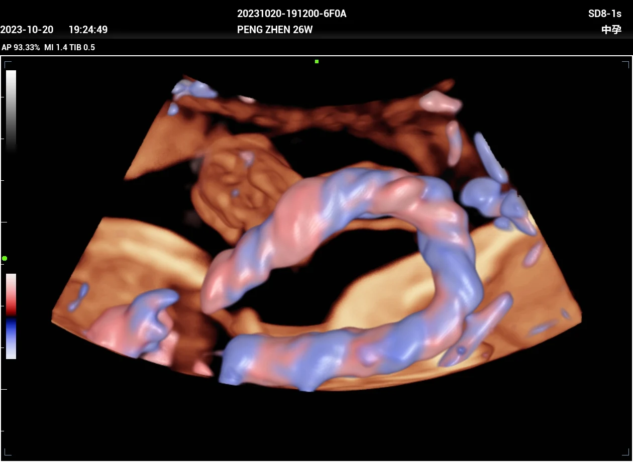 Cordón umbilical en 3D