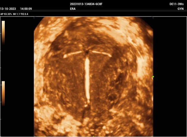 Dispositivo intrauterino