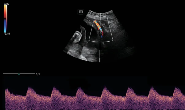Arteria uterina con PW