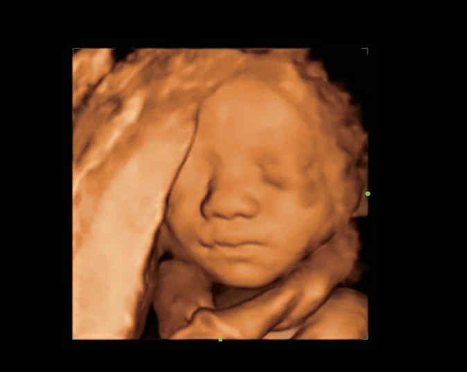 Cara fetal en 3D