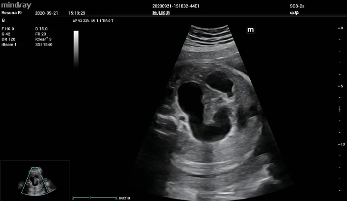 Dilatación gastrointestinal fetal