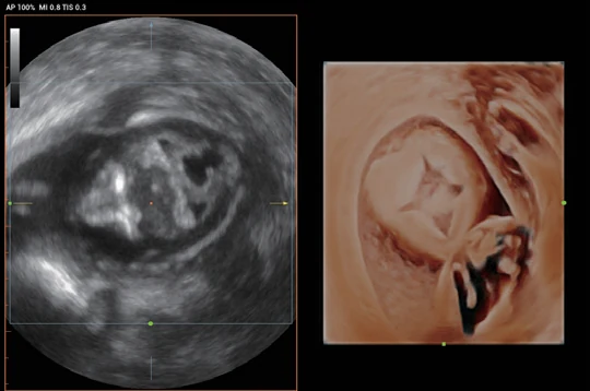 Malformación cerebral fetal