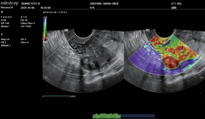 Elastografía de mioma uterino