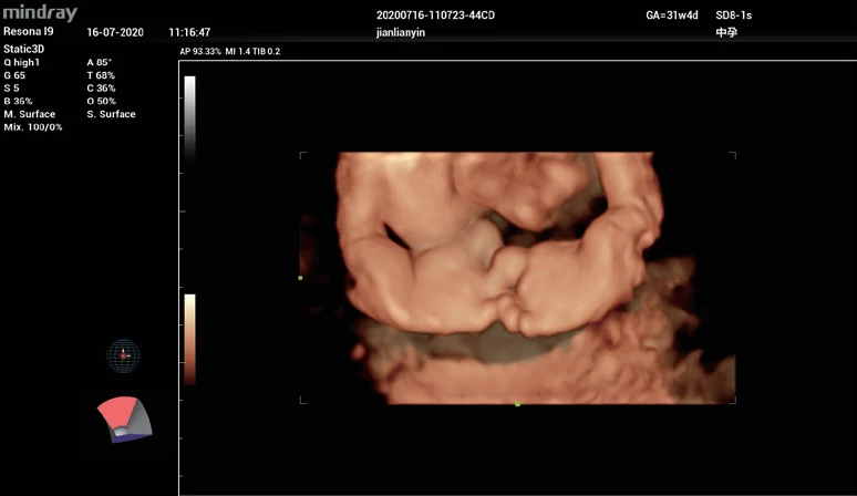Pie equinovaro fetal
