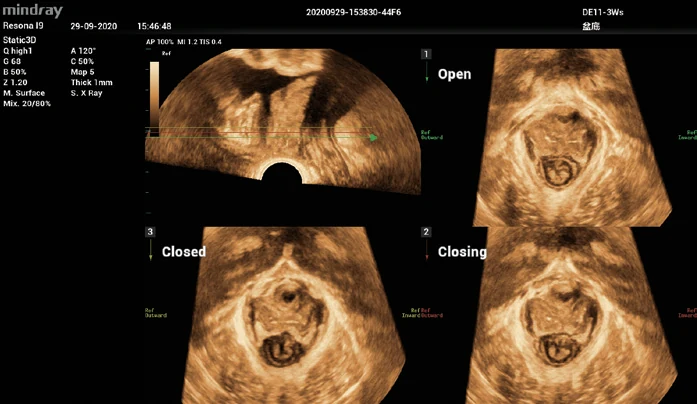 Suelo pélvico — Smart Pelvic