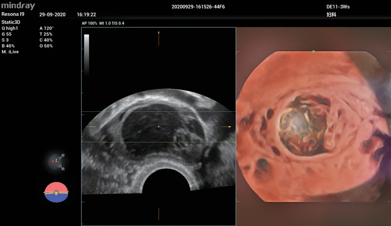 Tumor ovárico