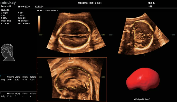 Medición automática del volumen intracraneal fetal Smart ICV en el Nuewa i9