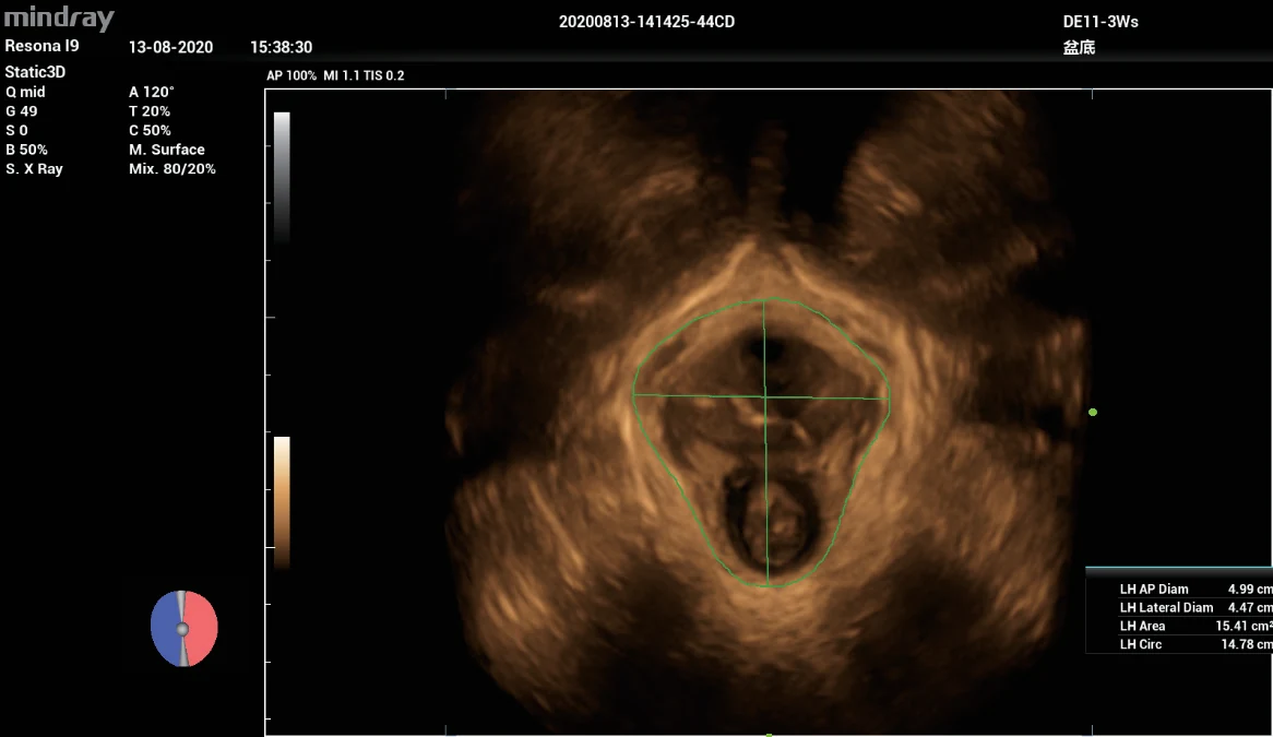 Evaluación automática del suelo pélvico Smart Pelvic en el Nuewa i9