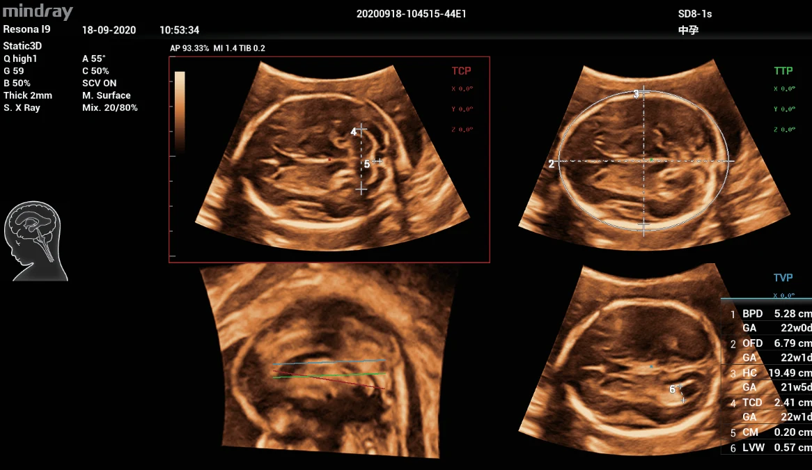 Detección automática de planos del sistema nervioso central fetal en el Nuewa i9