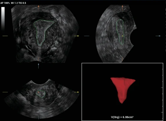 Análisis de receptividad endometrial Smart-V Trace en el Nuewa i9