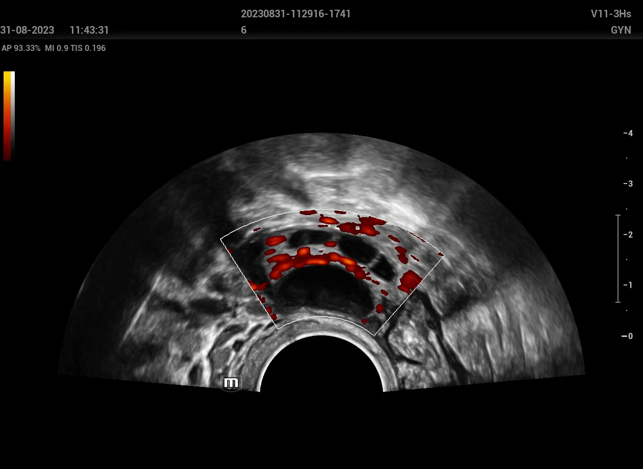 Ovario con Doppler power
