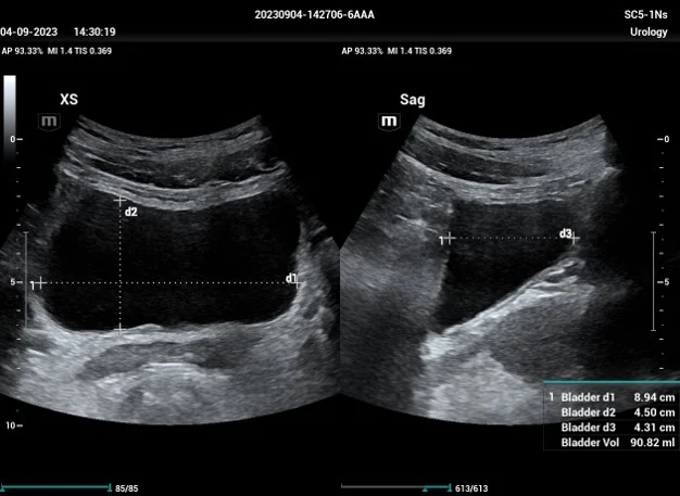 Smart Bladder