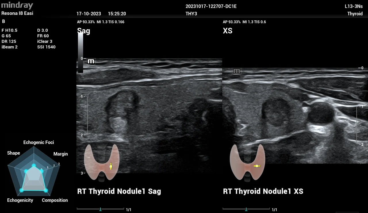 Smart Thyroid (TI-RADS)