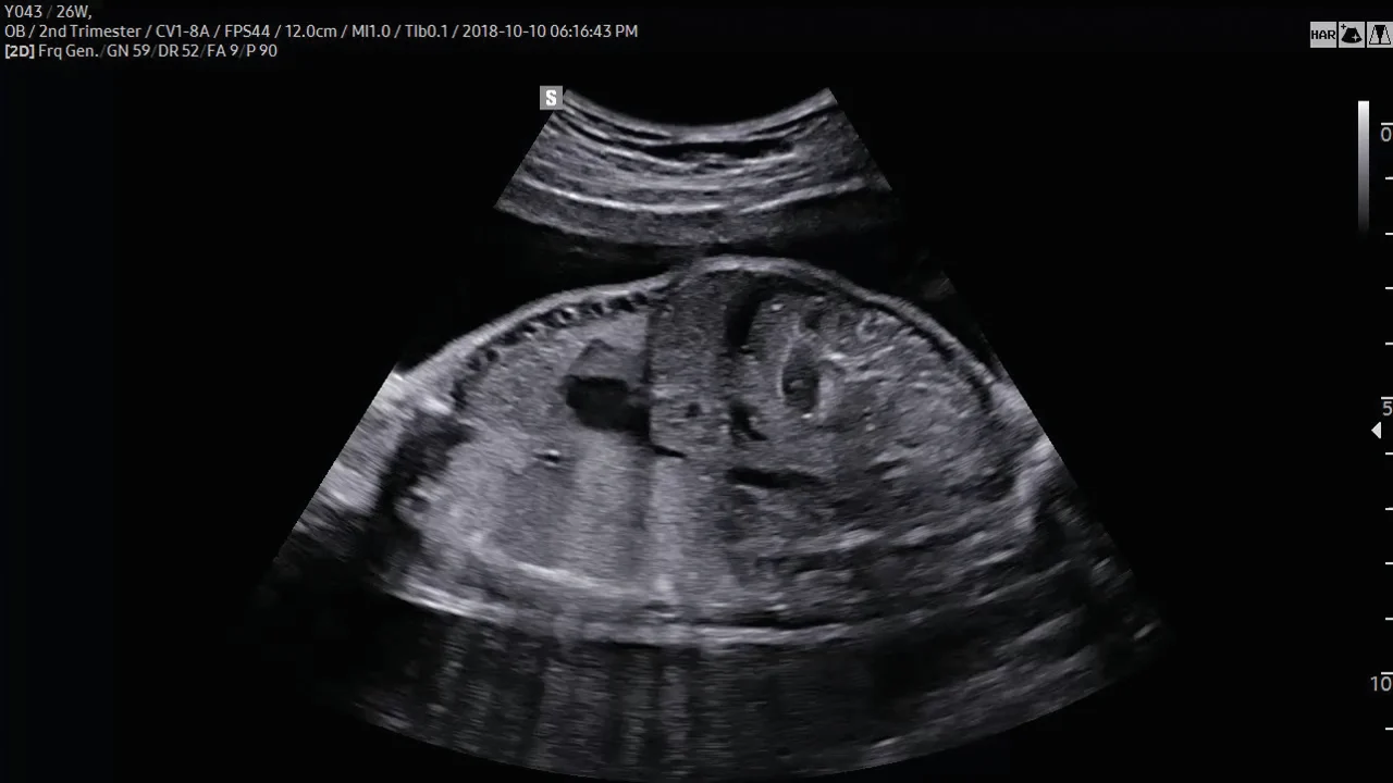 Abdomen fetal