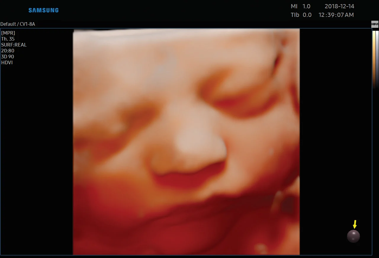 Cara fetal en el tercer trimestre con RealisticVue