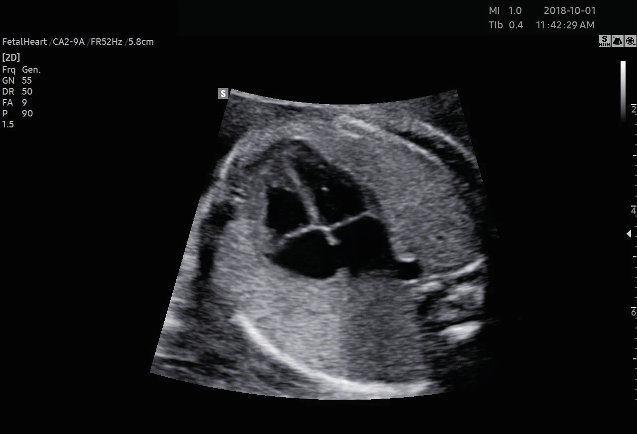 Corazón fetal, vista de cuatro cámaras