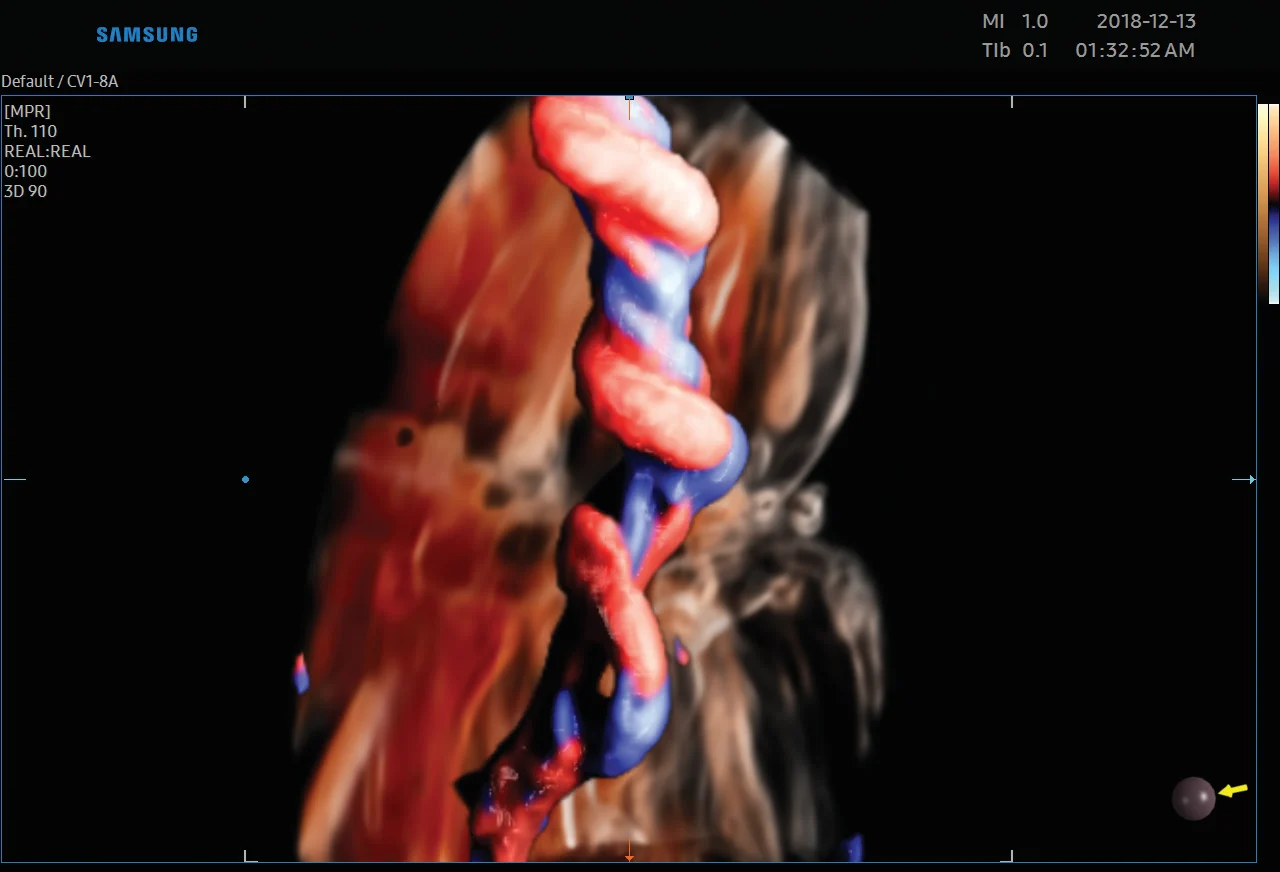 Cordón umbilical con CrystalVue Flow