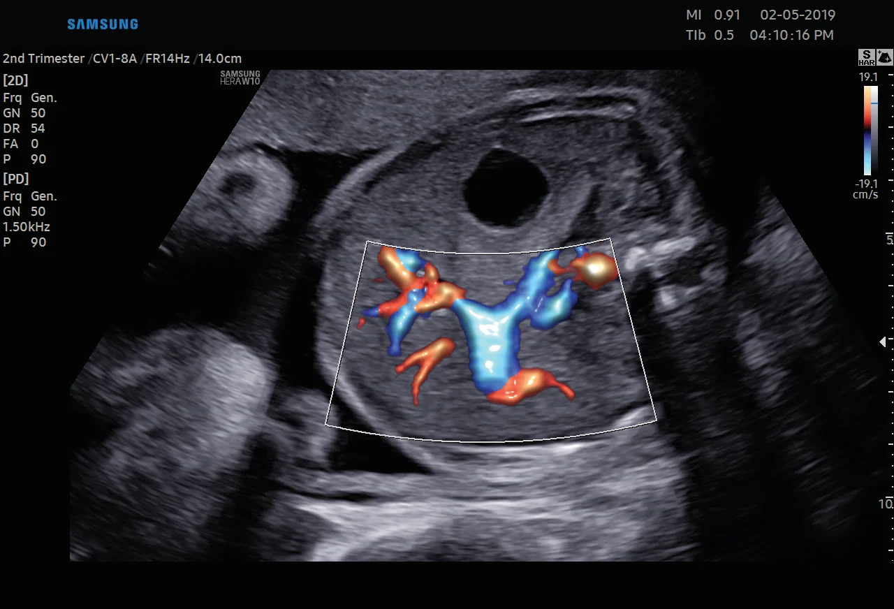 Flujo en color en el abdomen fetal