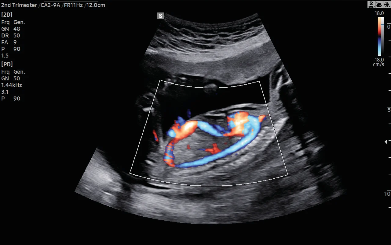 Flujo en color de la circulación fetal