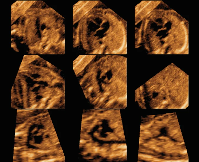 Las vistas del corazón fetal que genera 5D Heart en el Samsung Hera W10