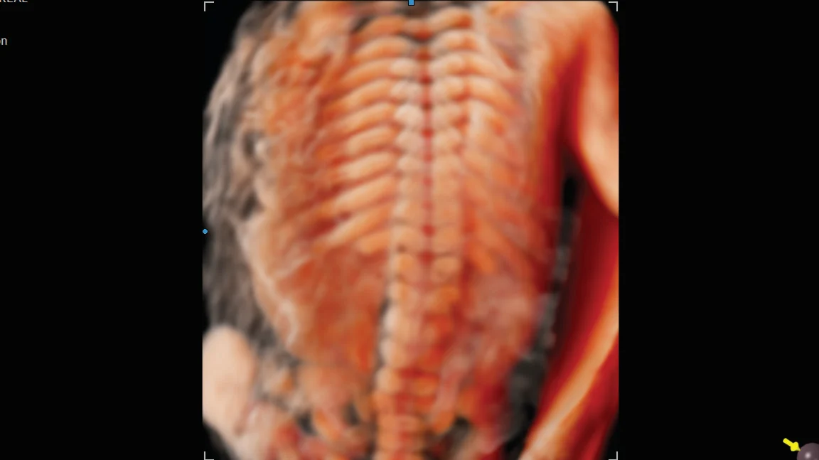 Columna fetal renderizada con CrystalVue en el Samsung Hera W10