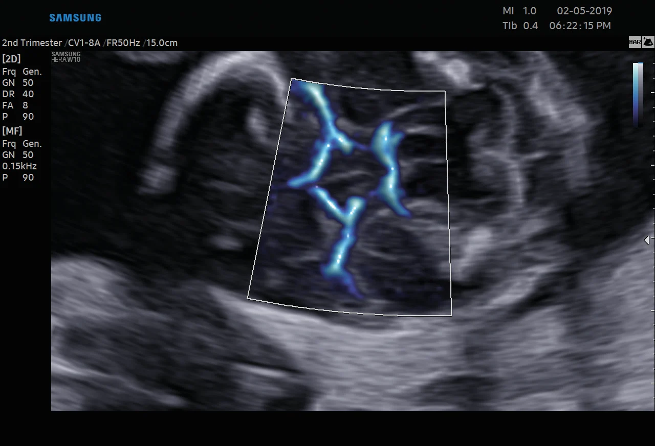 Polígono de Willis fetal con MV-Flow en el Samsung Hera W10