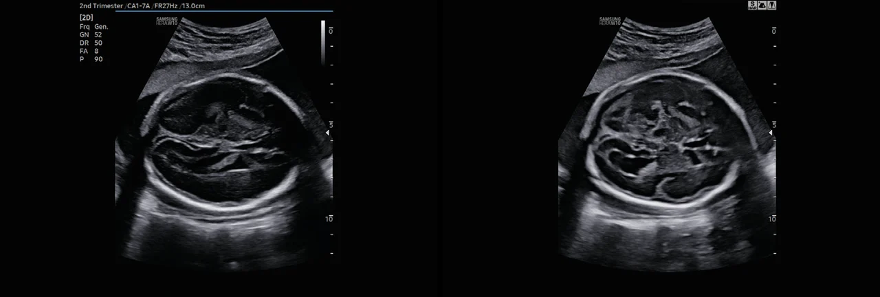 Cerebro fetal en el Samsung Hera W10 sin ShadowHDR (izquierda) y con ShadowHDR (derecha)