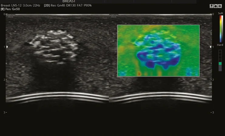 ElastoScan sobre un fantoma