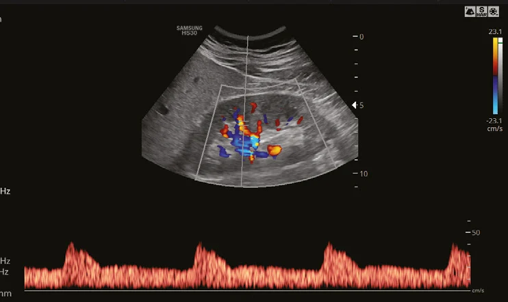 Doppler color de riñón con S-Harmonic