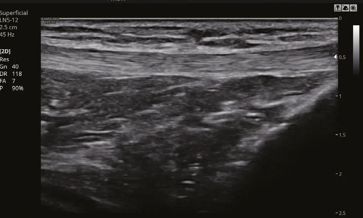 Rodilla con ClearVision