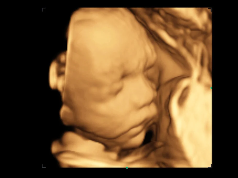 Cara fetal de 26 semanas en 3D
