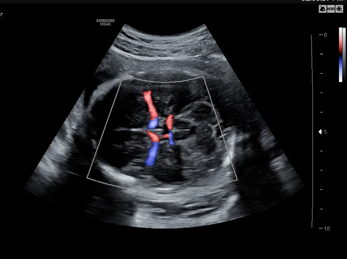 Cerebro fetal con S-Flow