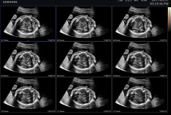 Cerebro fetal en vista multicorte