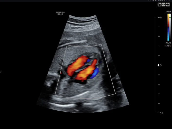 Corazón fetal con Doppler color