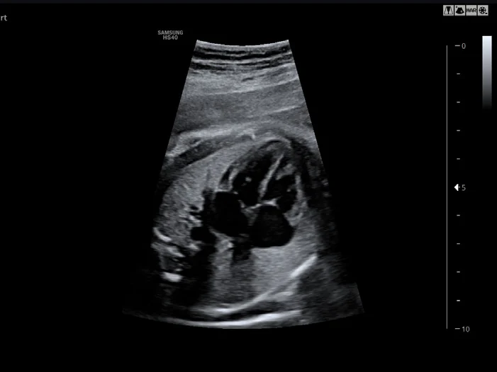 Corazón fetal