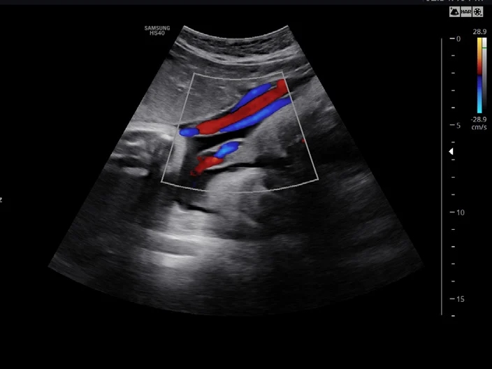 Cordón umbilical con Doppler color