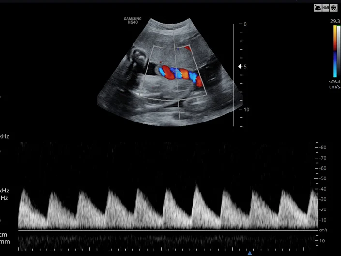 Cordón umbilical en Doppler pulsado