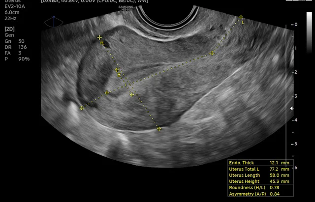 Útero con UterineAssist