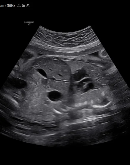 Abdomen fetal con ClearVision