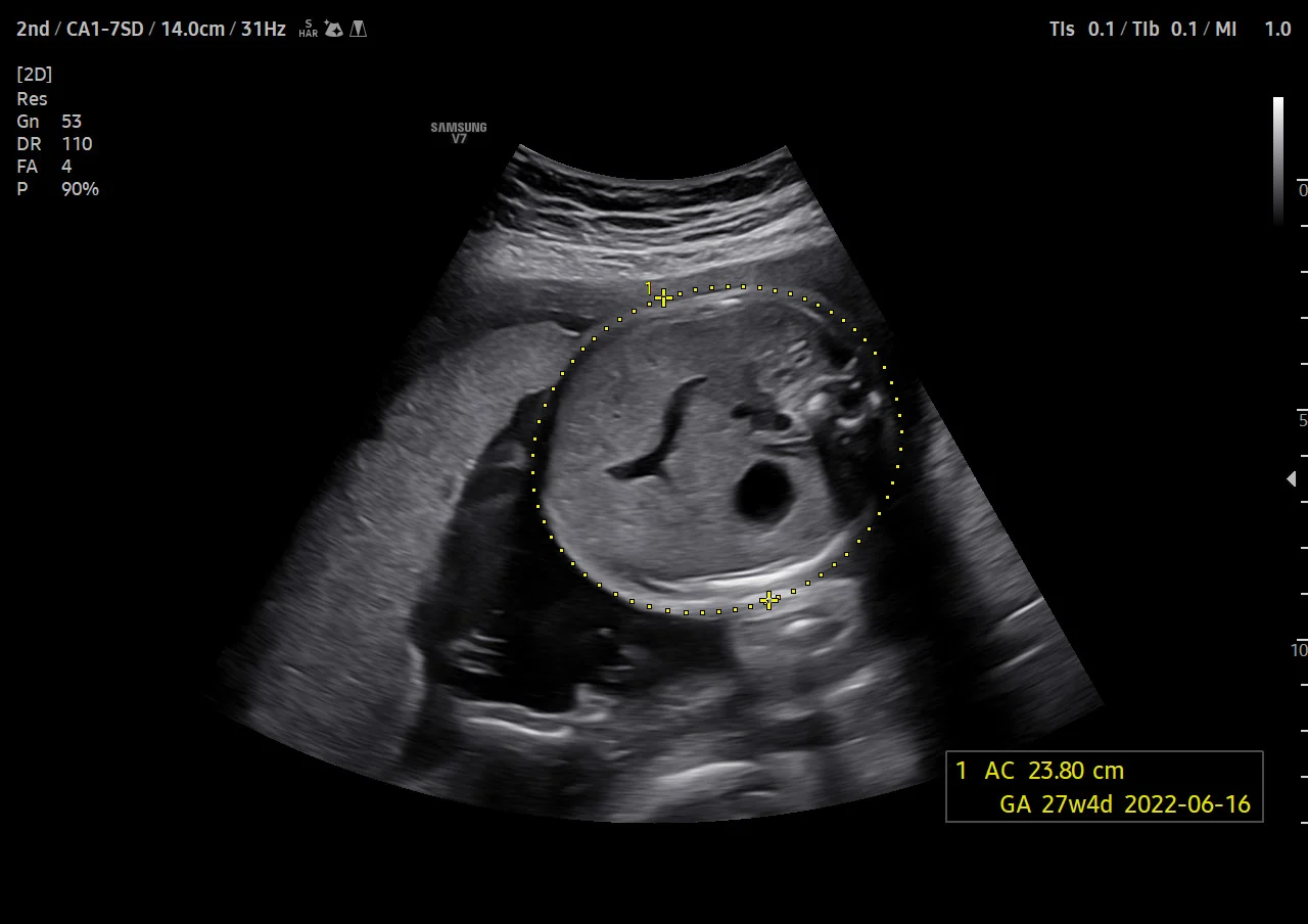 Biometría fetal con BiometryAssist