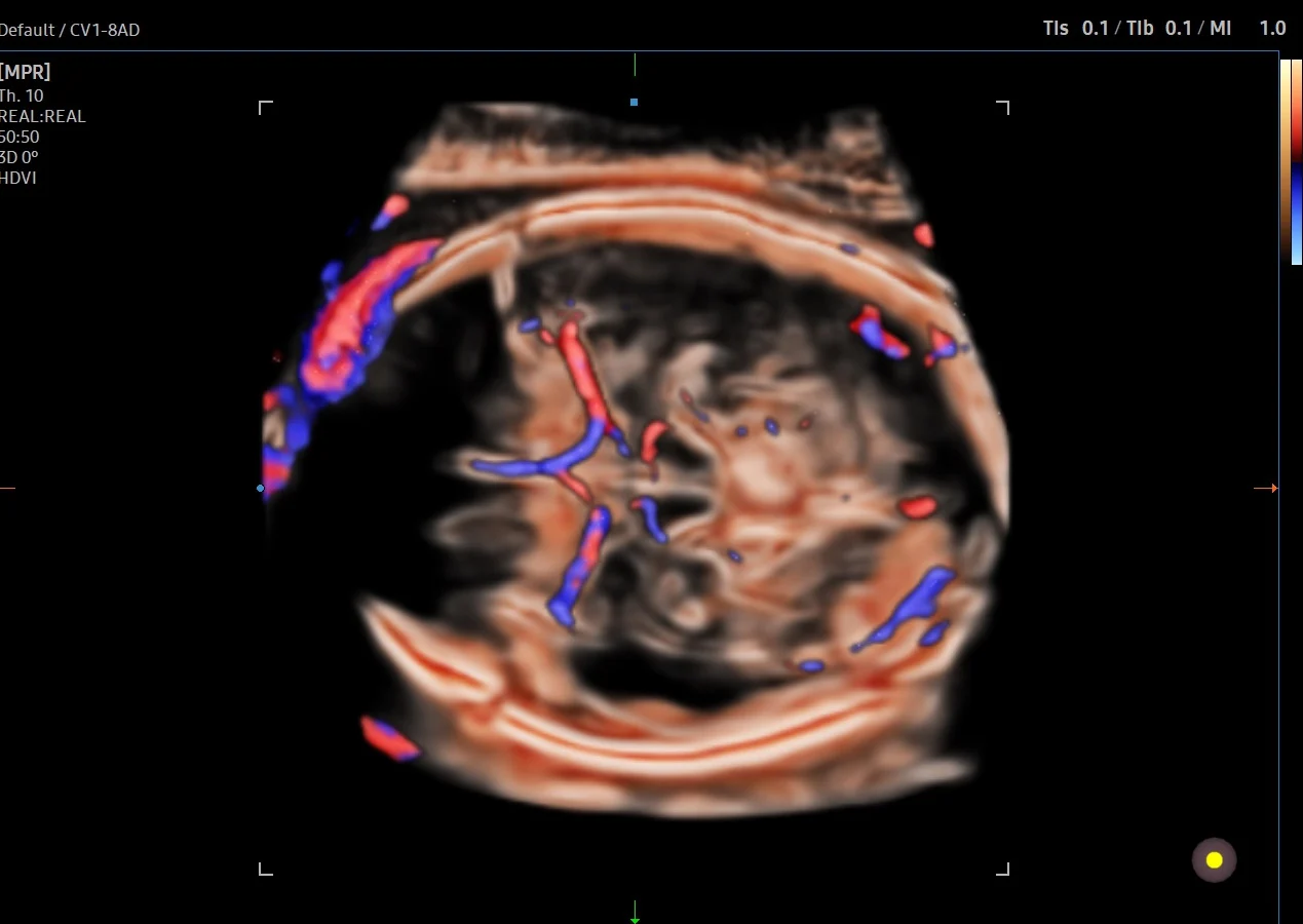 Cerebro fetal con CrystalVue Flow